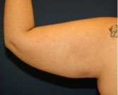 Feel Beautiful - Arm Reduction 202 - Before Photo